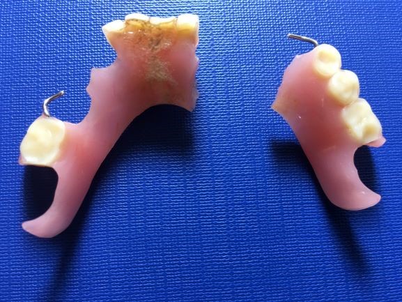 Emergency Denture Repairs