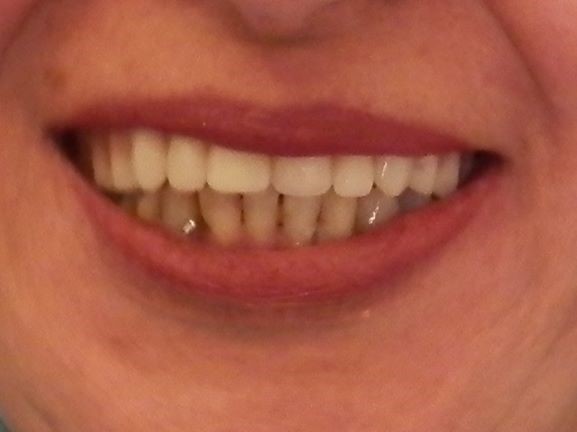 Loose dentures