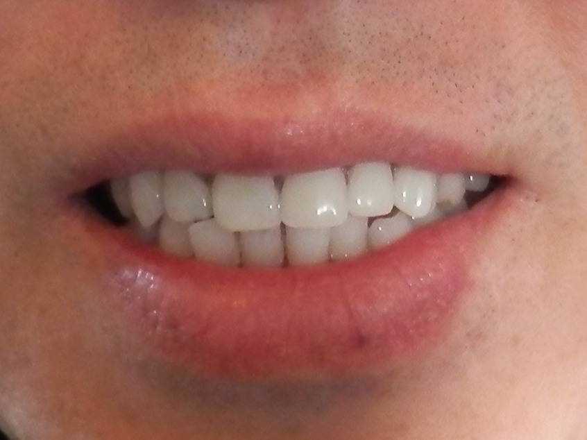 Partial Denture Front Teeth