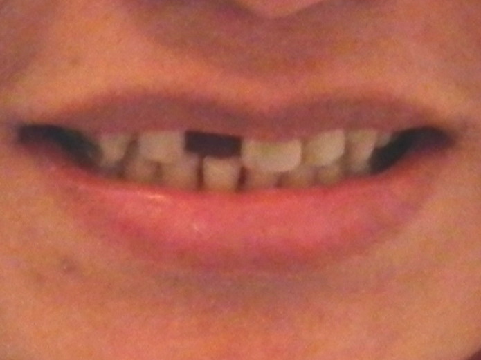 Partial Denture One Tooth