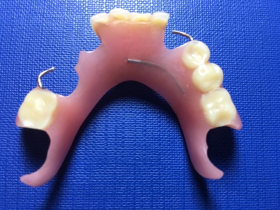 Repaired lower acrylic partial denture in a same day
