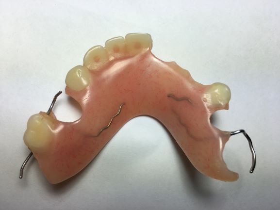 Emergency denture repairs for upper acrylic partial denture