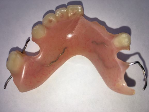 Broken upper acrylic parital denture for emergency denture repairs