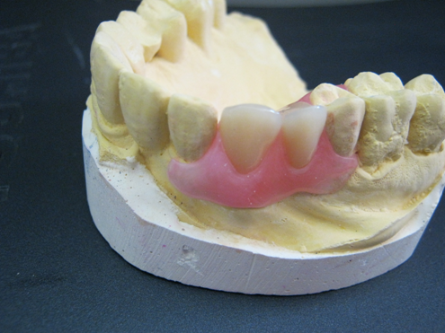 Cosmetic denture made of flexible denture material 