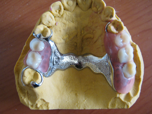 partial denture for back teeth