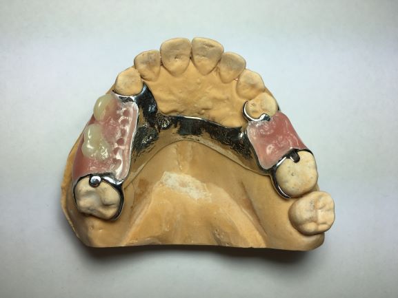 Partial denture upper 