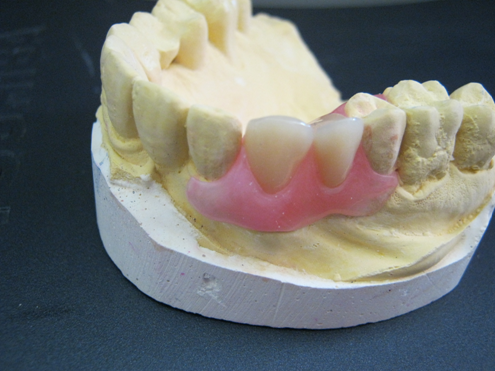 Partial Denture Flexible