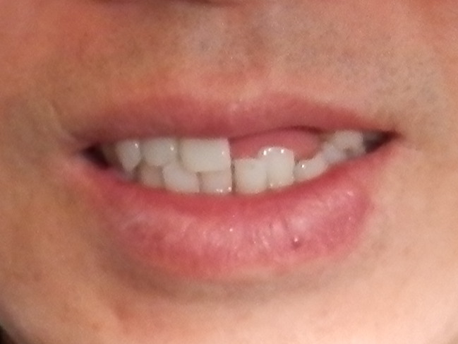 Exsiting Upper Metal Partial denture